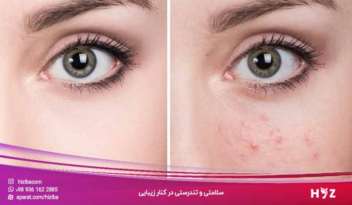 سریعترین روش از بین بردن جای جوش