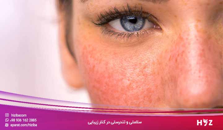 پماد برای جوش صورت