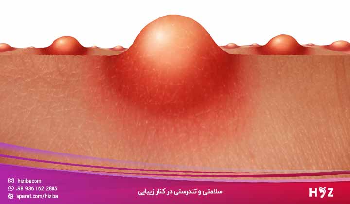 بهترین پماد برای جای جوش صورت